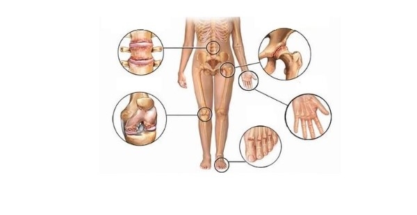 Czym jest reumatyzm tkanek miękkich?